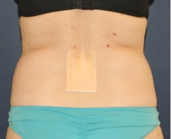 Liposuction Back-Flanks 211 - before - front
