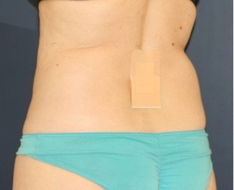 Liposuction Back-Flanks 211 - before - oblique