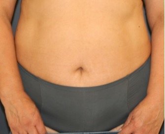 Tummy Tuck 233 - before - front