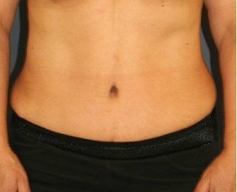 Tummy Tuck 233 - after - front