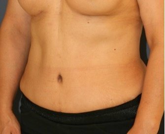 Tummy Tuck 233 - after - oblique