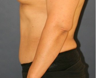 Tummy Tuck 233 - after - side