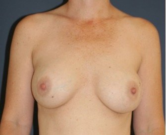 Breast Revision with Augmentation 410 - before - front