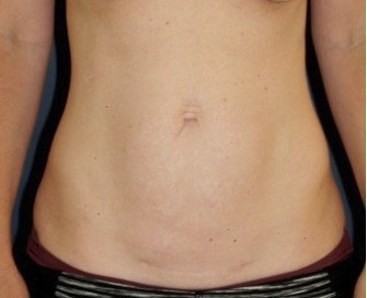 Tummy Tuck 234 - before - front