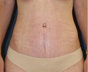 Tummy Tuck 234 - after - front