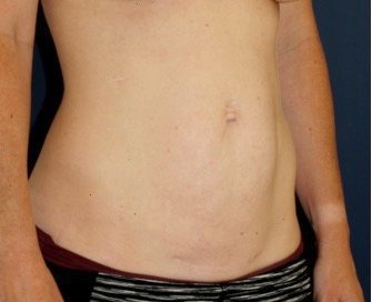 Tummy Tuck 234 - before - oblique