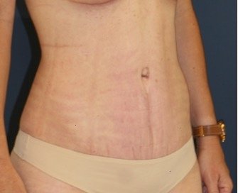 Tummy Tuck 234 - after - oblique