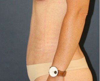 Tummy Tuck 234 - after - side