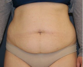 Tummy Tuck 235 - before - front