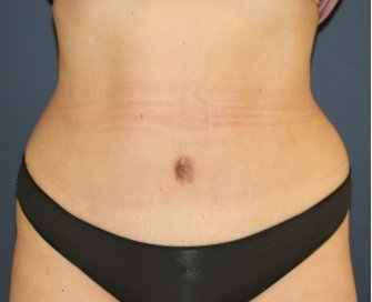 Tummy Tuck 235 - after - front