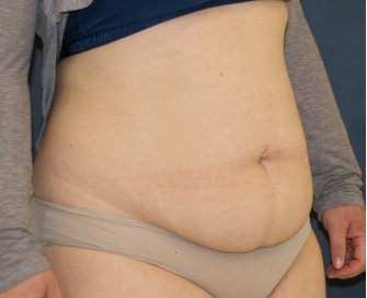 Tummy Tuck 235 - before - oblique