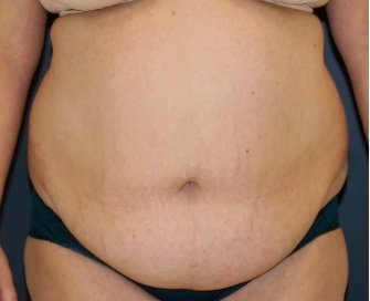 Tummy Tuck 236 - before - front