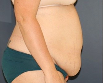 Tummy Tuck 236 - before - side