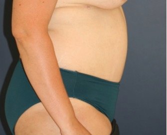 Tummy Tuck 236 - after - side