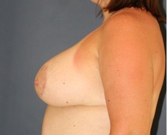 Breast Augmentation Lift 61 - after - side