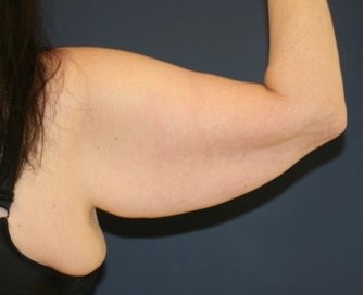 Arm Reduction 210 - before - front