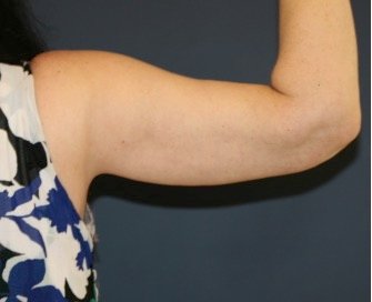 Arm Reduction 210 - after - front