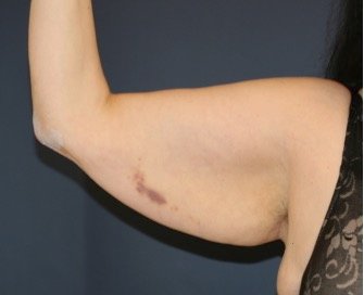 Arm Reduction 210 - before - oblique