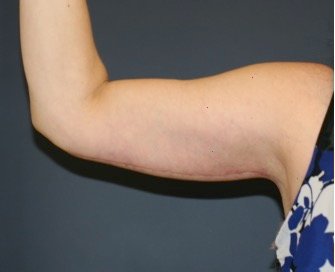 Arm Reduction 210 - after - oblique