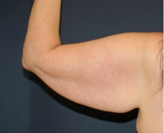 Arm Reduction 211 - before - front