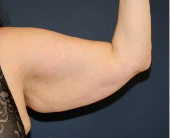 Arm Reduction 211 - before - oblique