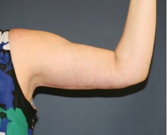 Arm Reduction 211 - after - oblique
