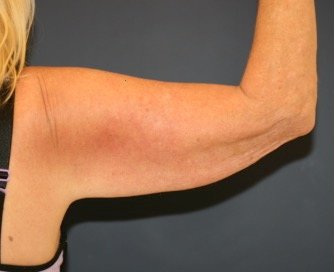 Arm Reduction 212 - before - front
