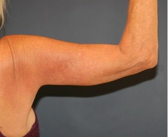 Arm Reduction 212 - after - front