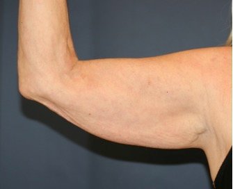 Arm Reduction 212 - before - oblique