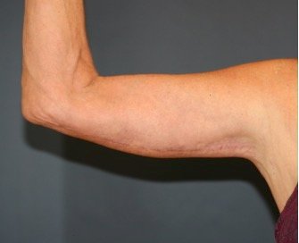 Arm Reduction 212 - after - oblique