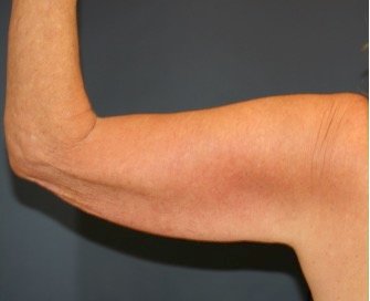 Arm Reduction 213 - before - front