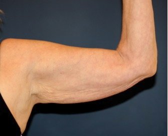 Arm Reduction 213 - before - oblique