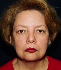 Facelift Case 4 - before - front