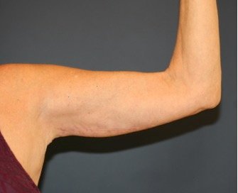Arm Reduction 213 - after - oblique
