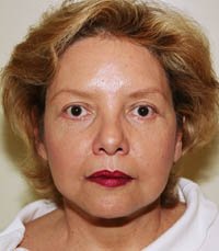 Facelift Case 4 - after - front