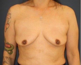 Breast Augmentation Lift 63 - before - front