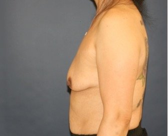 Breast Augmentation Lift 63 - before - side