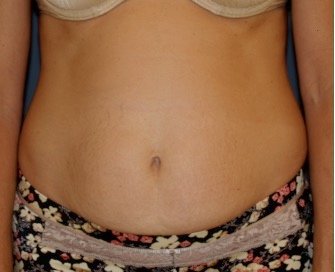 Tummy Tuck 237 - before - front