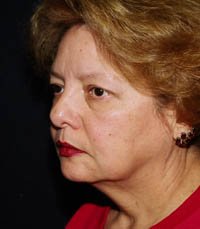 Facelift Case 4 - before - oblique