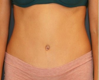 Tummy Tuck 237 - after - front