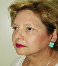 Facelift Case 4 - after - oblique