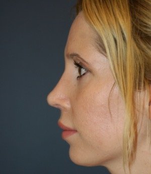 Rhinoplasty 212 - after - front