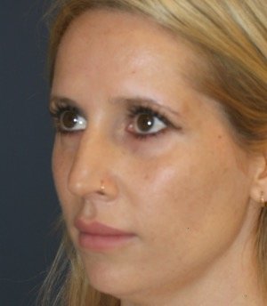 Rhinoplasty 212 - before - oblique