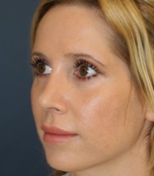 Rhinoplasty 212 - after - oblique