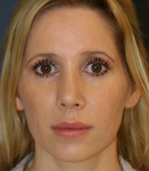 Rhinoplasty 212 - after - side