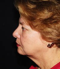 Facelift Case 4 - before - side