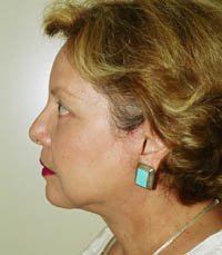 Facelift Case 4 - after - side
