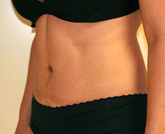 Tummy Tuck Case 8 - after - angle