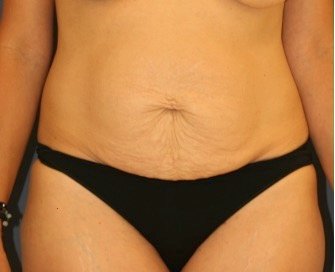 Tummy Tuck 238 - before - front