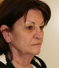Facelift Case 3 - before - oblique